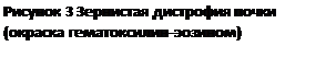 Подпись: Рисунок 3 Зернистая дистрофия почки (окраска гематоксилин-эозином)